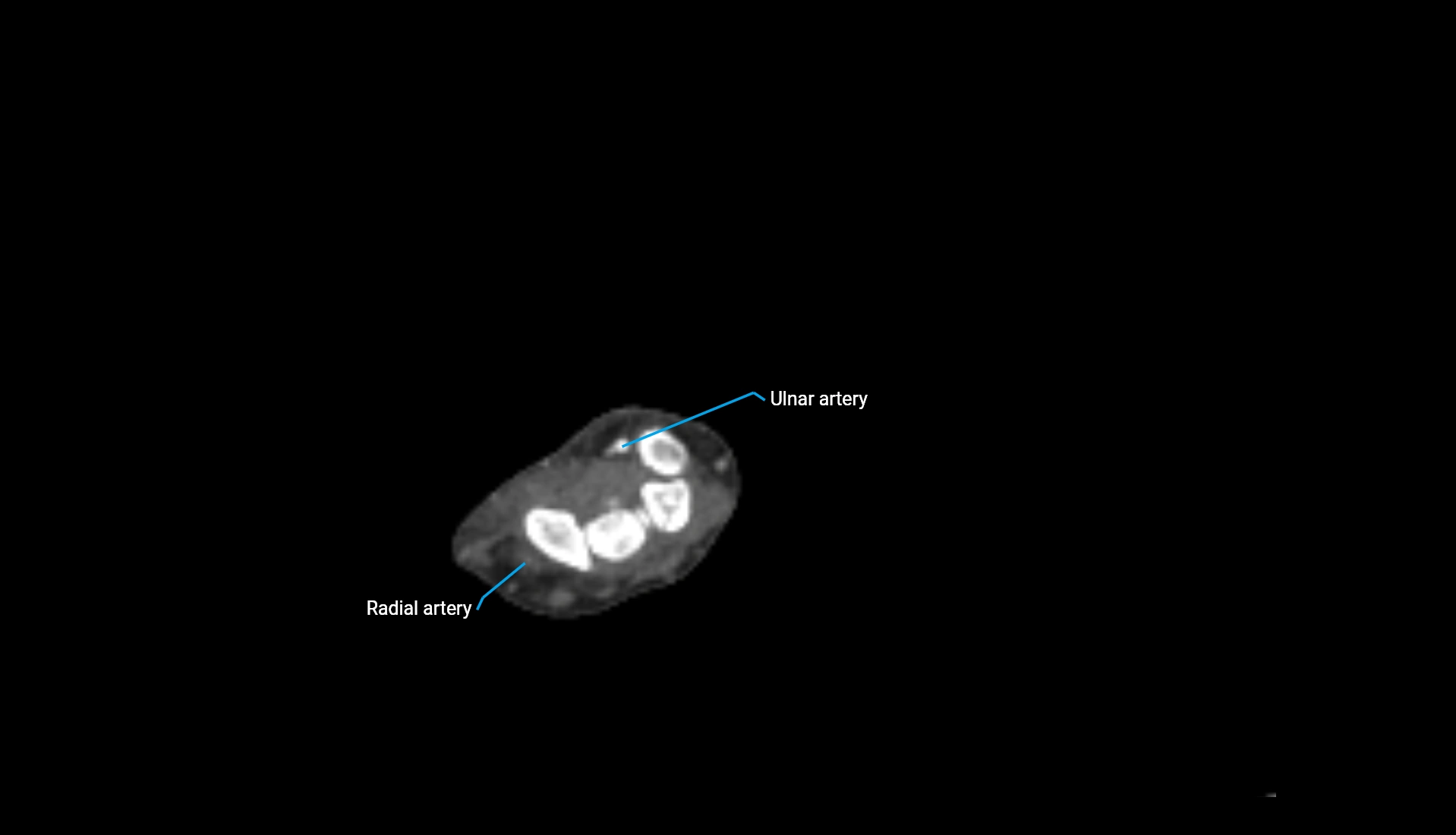 CTA upper limb axial cross sectional anatomy labelled image 76 (2).webp